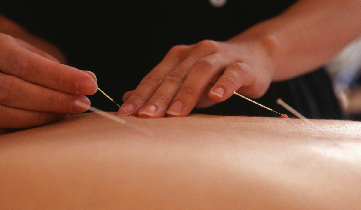 Can acupressure or acupuncture provide relief from pregnancy-related nausea?